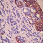 A new biomarker will help in diagnostic pancreatic cancer.